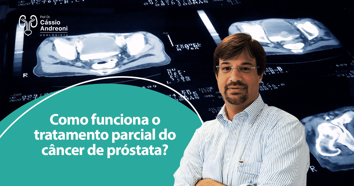 Como Funciona O Tratamento Parcial Do C Ncer De Pr Stata Dr C Ssio Andreoni Urologista Crm